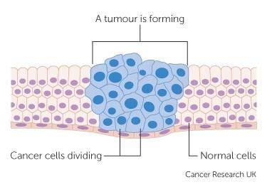 Article image of: Tumor Cell