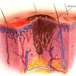 Article image of: Immunotherapy, The Most Prominent Topic In Skin Cancer Research