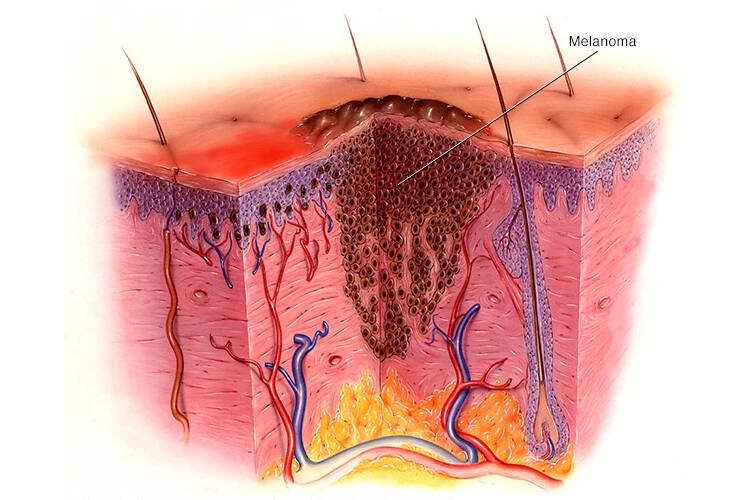 Article image of: Immunotherapy, The Most Prominent Topic In Skin Cancer Research