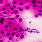 Article image of: Emmes Supports Groundbreaking Anal Cancer Study Sponsored by the National Cancer Institute