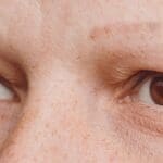 Article image of: Marketing authorisation for Baricitinib (Olumiant) for the treatment of severe alopecia areata