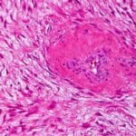 Article image of: New Data Regarding Desmoid Tumors at ESMO Congress 2022