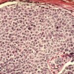 Article image of: Exploring the Importance of Human Tumor Cells in Cancer Research